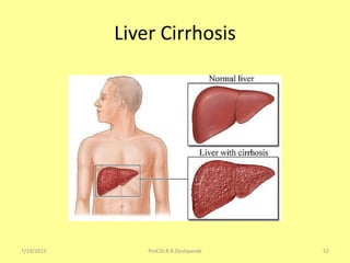 Liver Cirrhosis
7/19/2015 52Prof.Dr.R.R.Deshpande
 