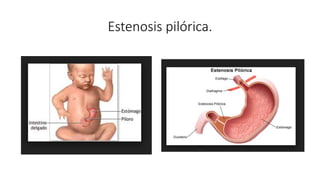 Estenosis pilórica.
 