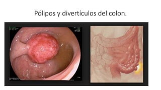 Pólipos y divertículos del colon.
 