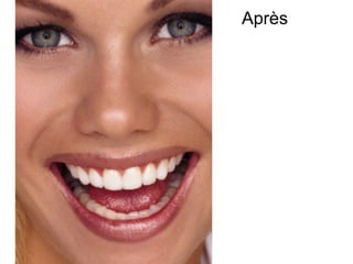 Après
 