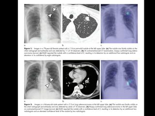 Nam et al
Figure 1: Images in a 78-year-old female patient with a 1.9-cm part-solid nodule at the left upper lobe. (a) The nodule was faintly visible on the
chest radiograph (arrowheads) and was detected by 11 of 18 observers. (b) At contrast-enhanced CT examination, biopsy conﬁrmed lung adeno-
carcinoma (arrow). (c) DLAD reported the nodule with a conﬁdence level of 2, resulting in its detection by an additional ﬁve radiologists and an
elevation in its conﬁdence by eight radiologists.
Figure 2: Images in a 64-year-old male patient with a 2.2-cm lung adenocarcinoma at the left upper lobe. (a) The nodule was faintly visible on
the chest radiograph (arrowheads) and was detected by seven of 18 observers. (b) Biopsy conﬁrmed lung adenocarcinoma in the left upper lobe
on contrast-enhanced CT image (arrow). (c) DLAD reported the nodule with a conﬁdence level of 2, resulting in its detection by an additional two
radiologists and an elevated conﬁdence level of the nodule by two radiologists.
 