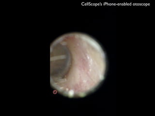 CellScope’s iPhone-enabled otoscope
 