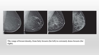 The range of breast density, from fatty breasts (far left) to extremely dense breasts (far
right).
 
