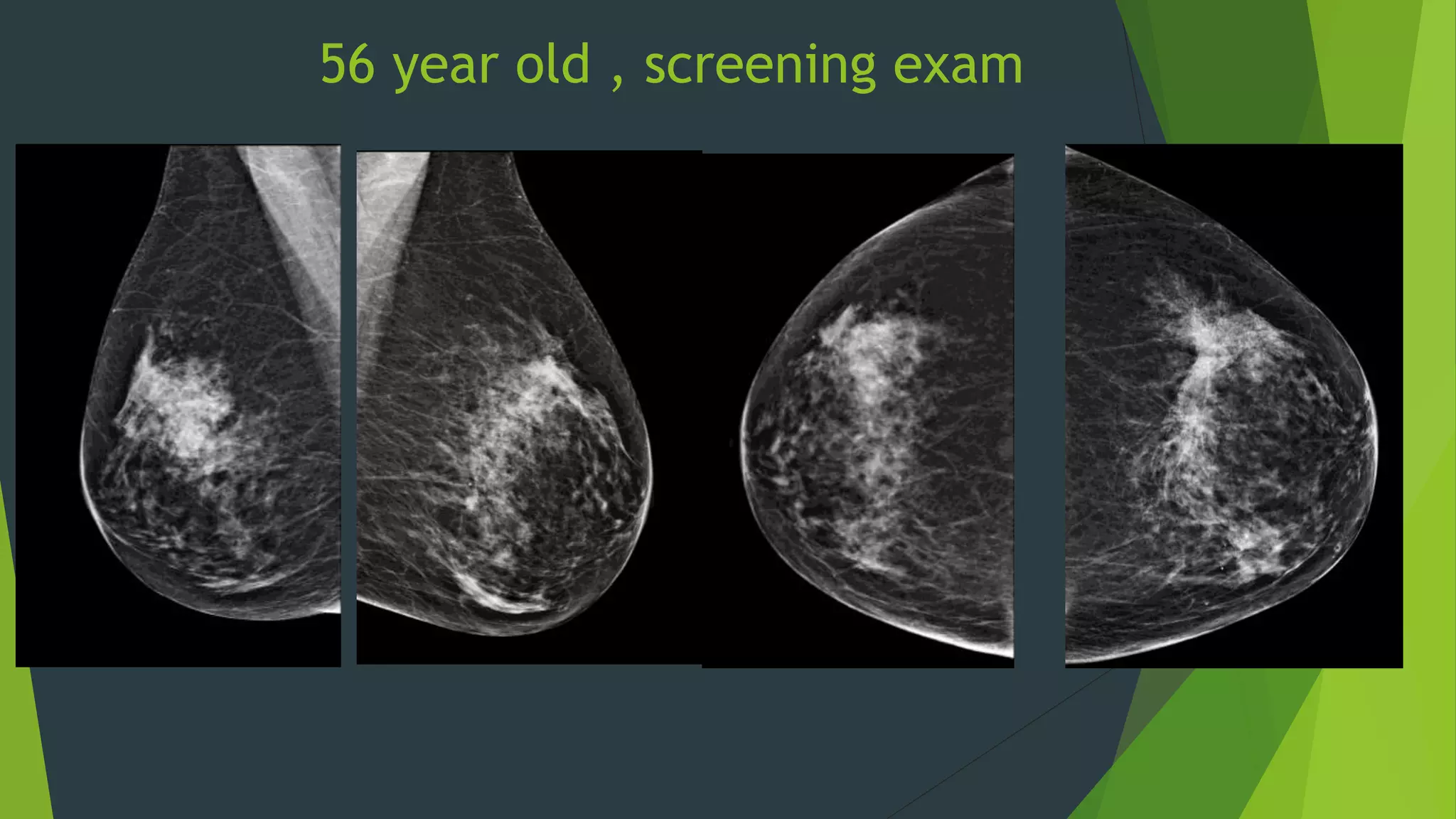 56 year old , screening exam
 