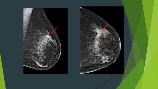 Tomosynthesis image