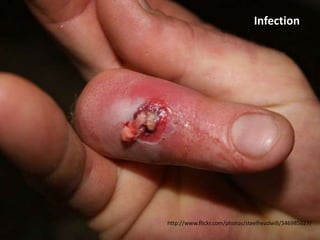 Infection




http://www.flickr.com/photos/steelheadwill/346985627/
 