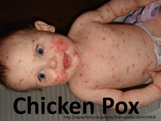 Chicken Pox
    http://www.flickr.com/photos/themaxsons/2849159830
 