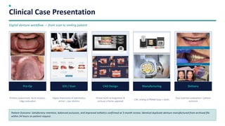 Digital Dentures: Revolutionizing Complete Denture Fabrication with CAD ...