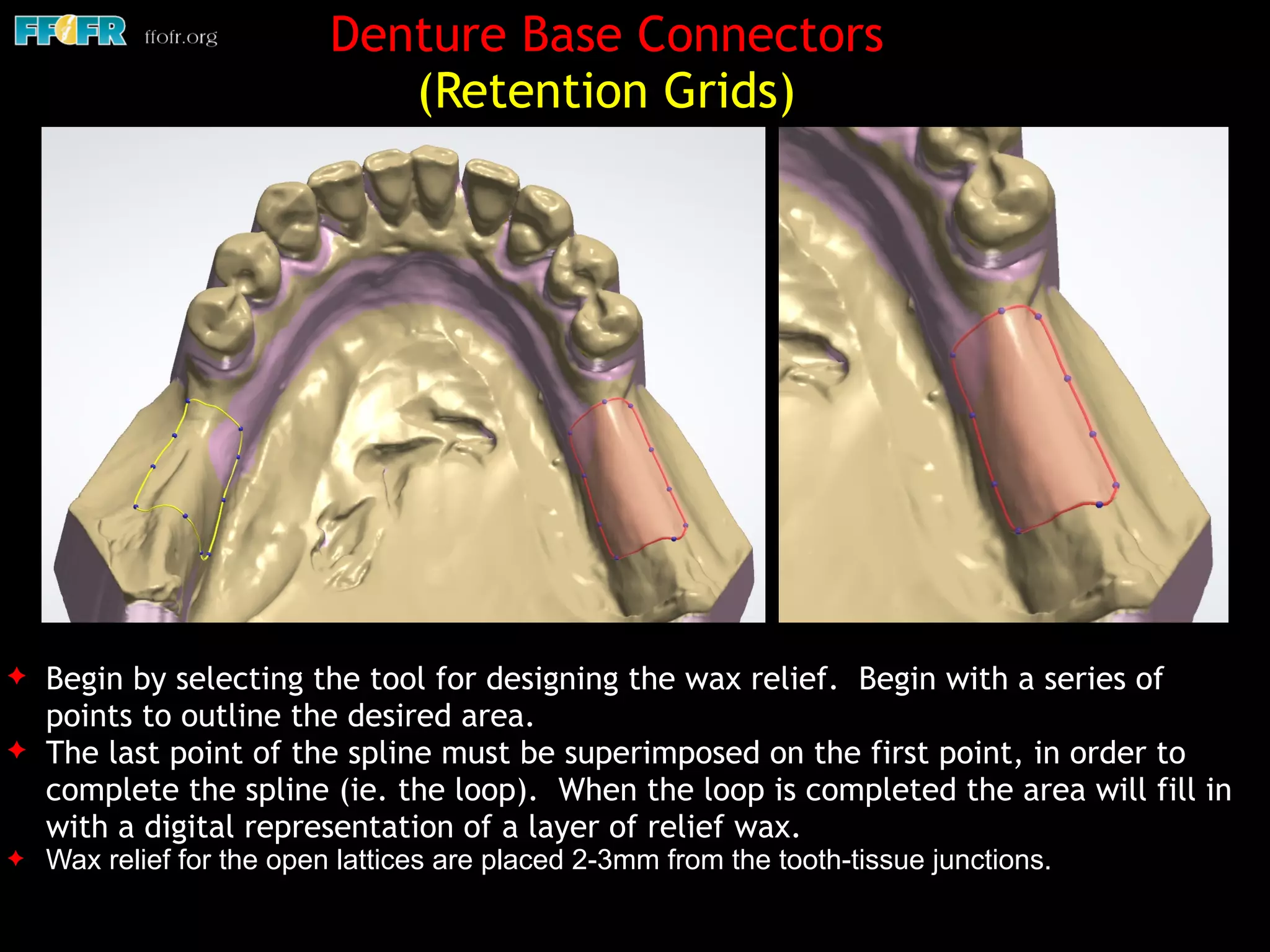 Denture Base Connectors
(Retention Grids)
✦ Begin by selecting the tool for designing the wax relief. Begin with a series of
points to outline the desired area.
✦ The last point of the spline must be superimposed on the first point, in order to
complete the spline (ie. the loop). When the loop is completed the area will fill in
with a digital representation of a layer of relief wax.
✦ Wax relief for the open lattices are placed 2-3mm from the tooth-tissue junctions.
 
