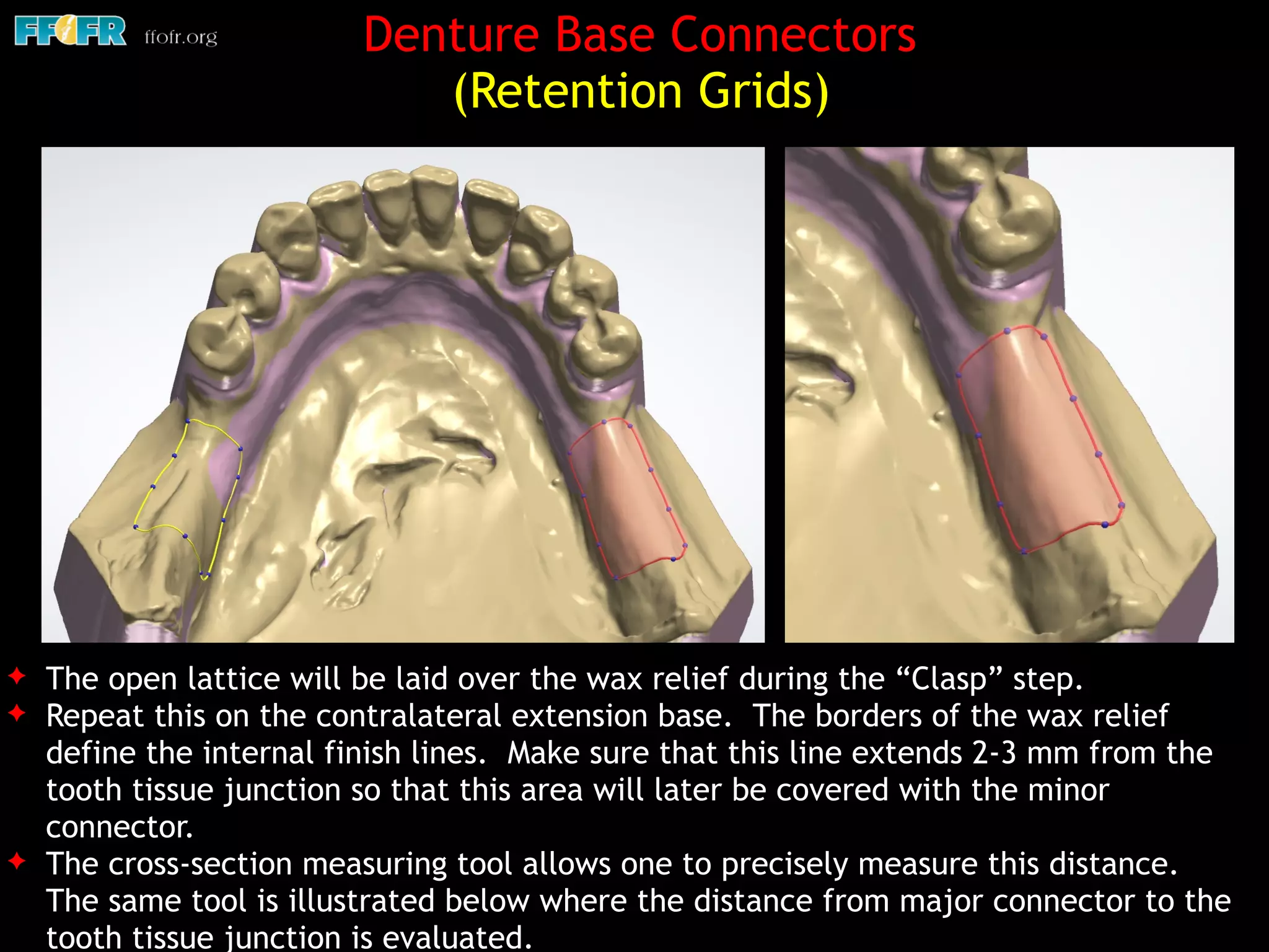 Denture Base Connectors
(Retention Grids)
✦ The open lattice will be laid over the wax relief during the “Clasp” step.
✦ Repeat this on the contralateral extension base. The borders of the wax relief
define the internal finish lines. Make sure that this line extends 2-3 mm from the
tooth tissue junction so that this area will later be covered with the minor
connector.
✦ The cross-section measuring tool allows one to precisely measure this distance.
The same tool is illustrated below where the distance from major connector to the
tooth tissue junction is evaluated.
 