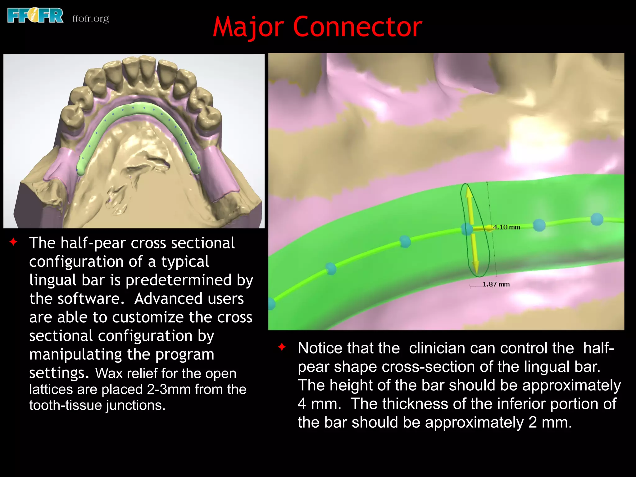 Major Connector
✦ The half-pear cross sectional
configuration of a typical
lingual bar is predetermined by
the software. Advanced users
are able to customize the cross
sectional configuration by
manipulating the program
settings. Wax relief for the open
lattices are placed 2-3mm from the
tooth-tissue junctions.
✦ Notice that the clinician can control the half-
pear shape cross-section of the lingual bar.
The height of the bar should be approximately
4 mm. The thickness of the inferior portion of
the bar should be approximately 2 mm.
 