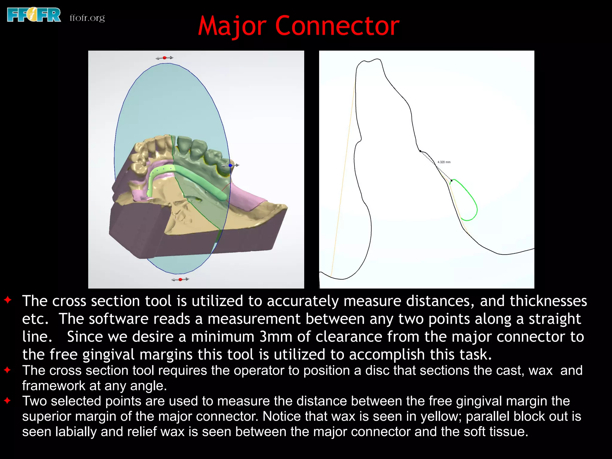 ✦ The cross section tool is utilized to accurately measure distances, and thicknesses
etc. The software reads a measurement between any two points along a straight
line. Since we desire a minimum 3mm of clearance from the major connector to
the free gingival margins this tool is utilized to accomplish this task.
✦ The cross section tool requires the operator to position a disc that sections the cast, wax and
framework at any angle.
✦ Two selected points are used to measure the distance between the free gingival margin the
superior margin of the major connector. Notice that wax is seen in yellow; parallel block out is
seen labially and relief wax is seen between the major connector and the soft tissue.
Major Connector
 