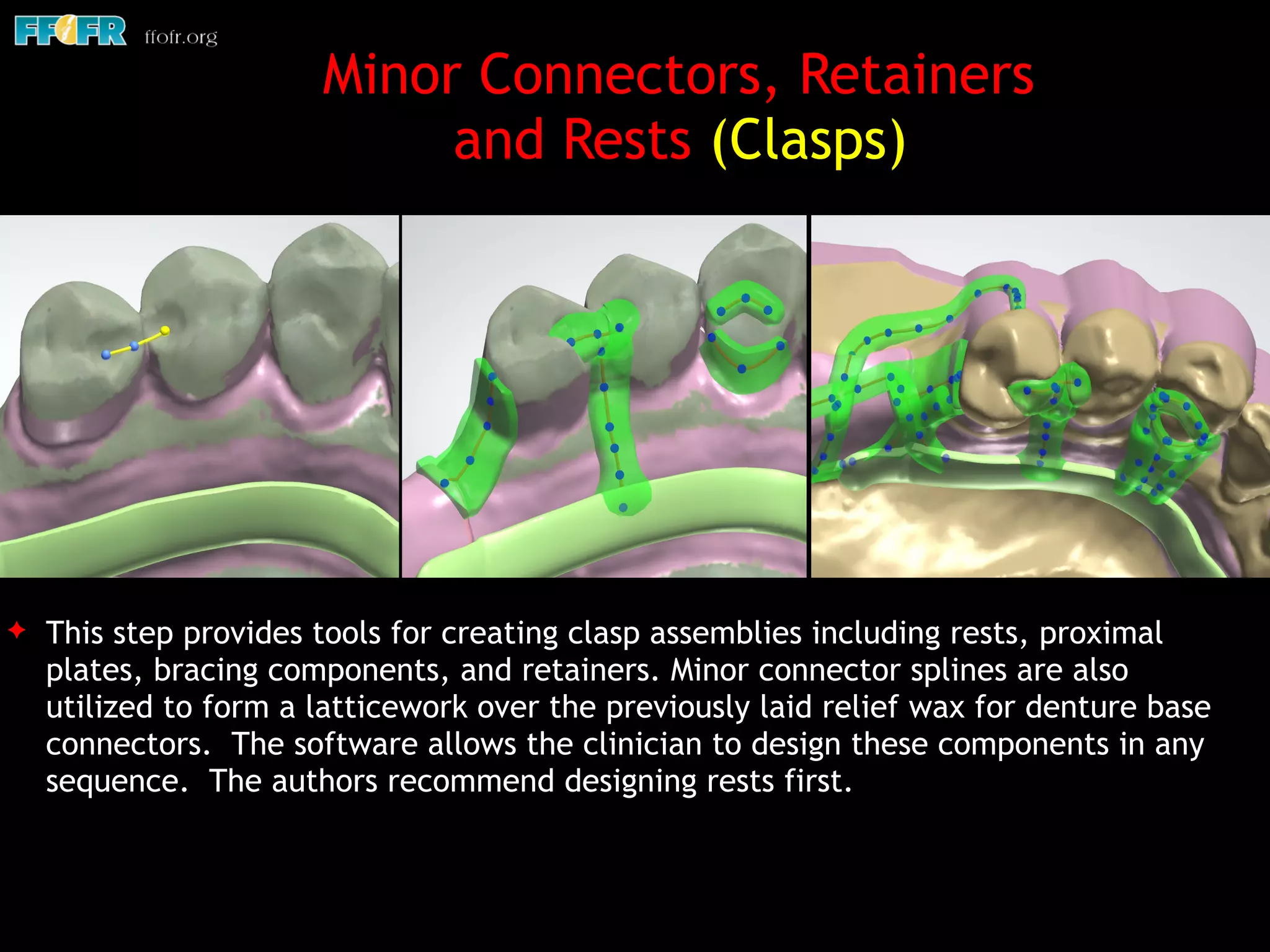 ✦ This step provides tools for creating clasp assemblies including rests, proximal
plates, bracing components, and retainers. Minor connector splines are also
utilized to form a latticework over the previously laid relief wax for denture base
connectors. The software allows the clinician to design these components in any
sequence. The authors recommend designing rests first.
Minor Connectors, Retainers
and Rests (Clasps)
 