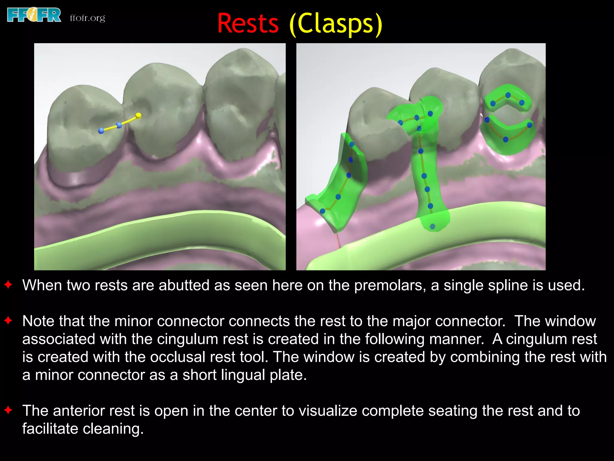 ✦ When two rests are abutted as seen here on the premolars, a single spline is used.
✦ Note that the minor connector connects the rest to the major connector. The window
associated with the cingulum rest is created in the following manner. A cingulum rest
is created with the occlusal rest tool. The window is created by combining the rest with
a minor connector as a short lingual plate.
✦ The anterior rest is open in the center to visualize complete seating the rest and to
facilitate cleaning.
Rests (Clasps)
 
