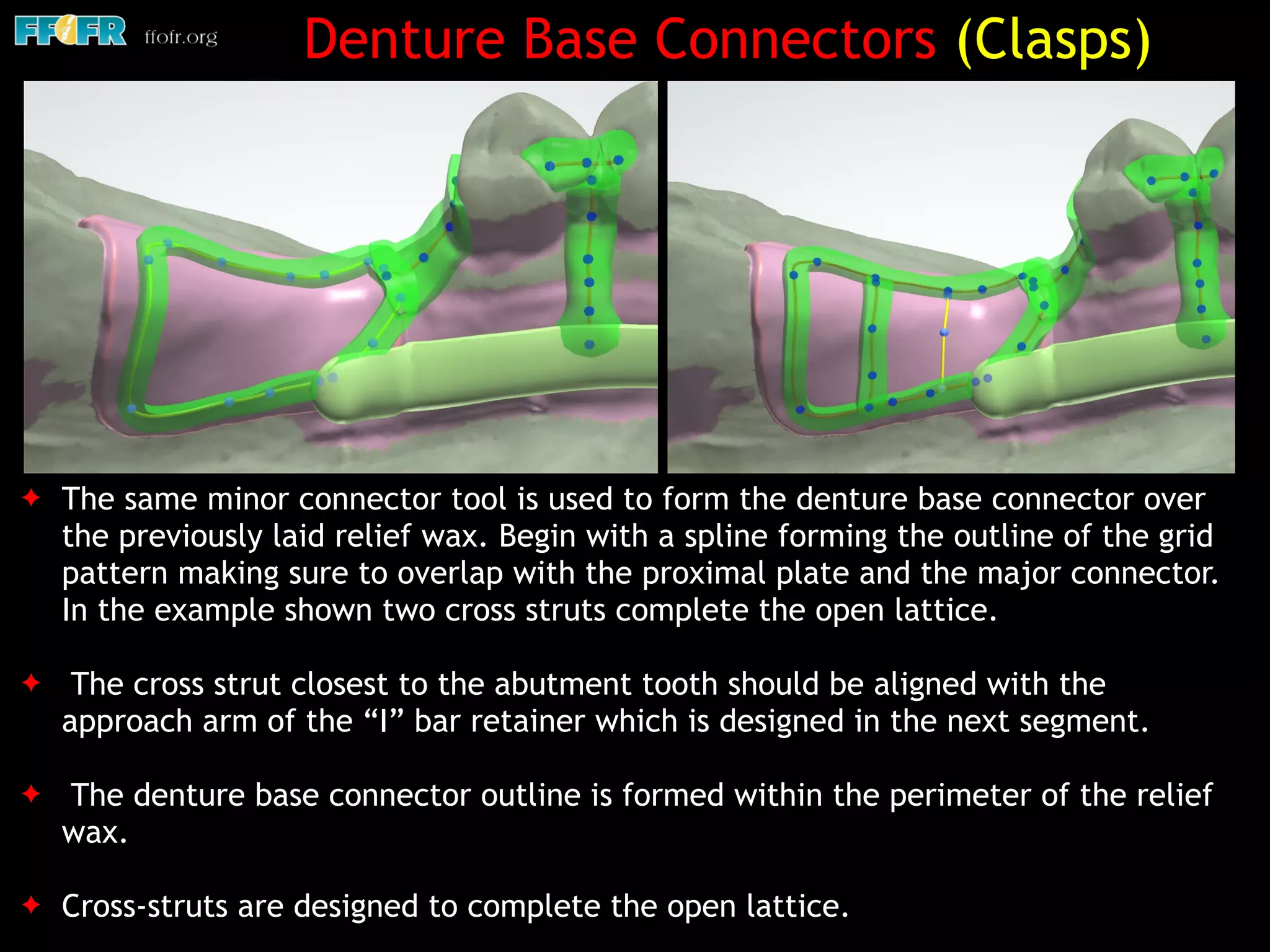 ✦ The same minor connector tool is used to form the denture base connector over
the previously laid relief wax. Begin with a spline forming the outline of the grid
pattern making sure to overlap with the proximal plate and the major connector.
In the example shown two cross struts complete the open lattice.
✦ The cross strut closest to the abutment tooth should be aligned with the
approach arm of the “I” bar retainer which is designed in the next segment.
✦ The denture base connector outline is formed within the perimeter of the relief
wax.
✦ Cross-struts are designed to complete the open lattice.
Denture Base Connectors (Clasps)
 