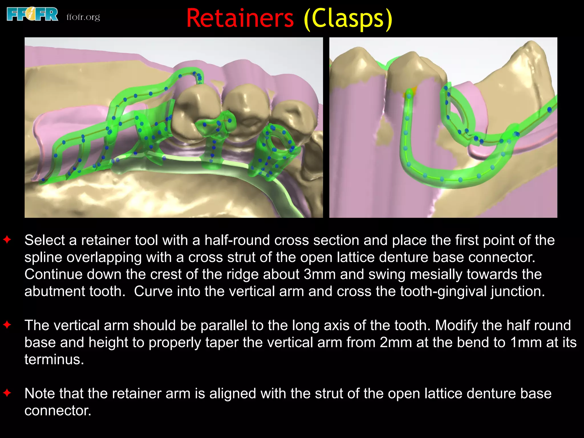 ✦ Select a retainer tool with a half-round cross section and place the first point of the
spline overlapping with a cross strut of the open lattice denture base connector.
Continue down the crest of the ridge about 3mm and swing mesially towards the
abutment tooth. Curve into the vertical arm and cross the tooth-gingival junction.
✦ The vertical arm should be parallel to the long axis of the tooth. Modify the half round
base and height to properly taper the vertical arm from 2mm at the bend to 1mm at its
terminus.
✦ Note that the retainer arm is aligned with the strut of the open lattice denture base
connector.
Retainers (Clasps)
 