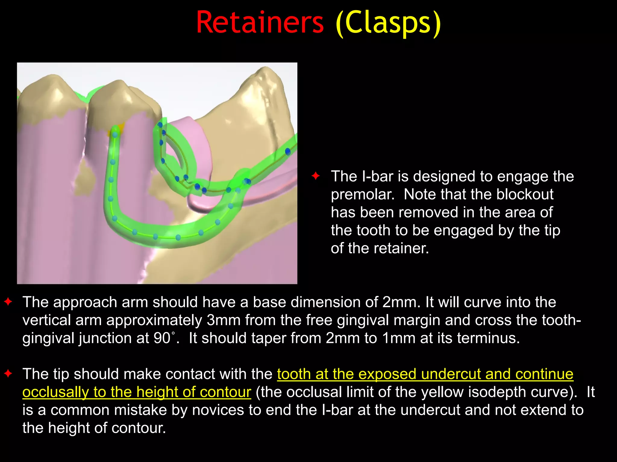 Retainers (Clasps)
✦ The approach arm should have a base dimension of 2mm. It will curve into the
vertical arm approximately 3mm from the free gingival margin and cross the tooth-
gingival junction at 90˚. It should taper from 2mm to 1mm at its terminus.
✦ The tip should make contact with the tooth at the exposed undercut and continue
occlusally to the height of contour (the occlusal limit of the yellow isodepth curve). It
is a common mistake by novices to end the I-bar at the undercut and not extend to
the height of contour.
✦ The I-bar is designed to engage the
premolar. Note that the blockout
has been removed in the area of
the tooth to be engaged by the tip
of the retainer.
 