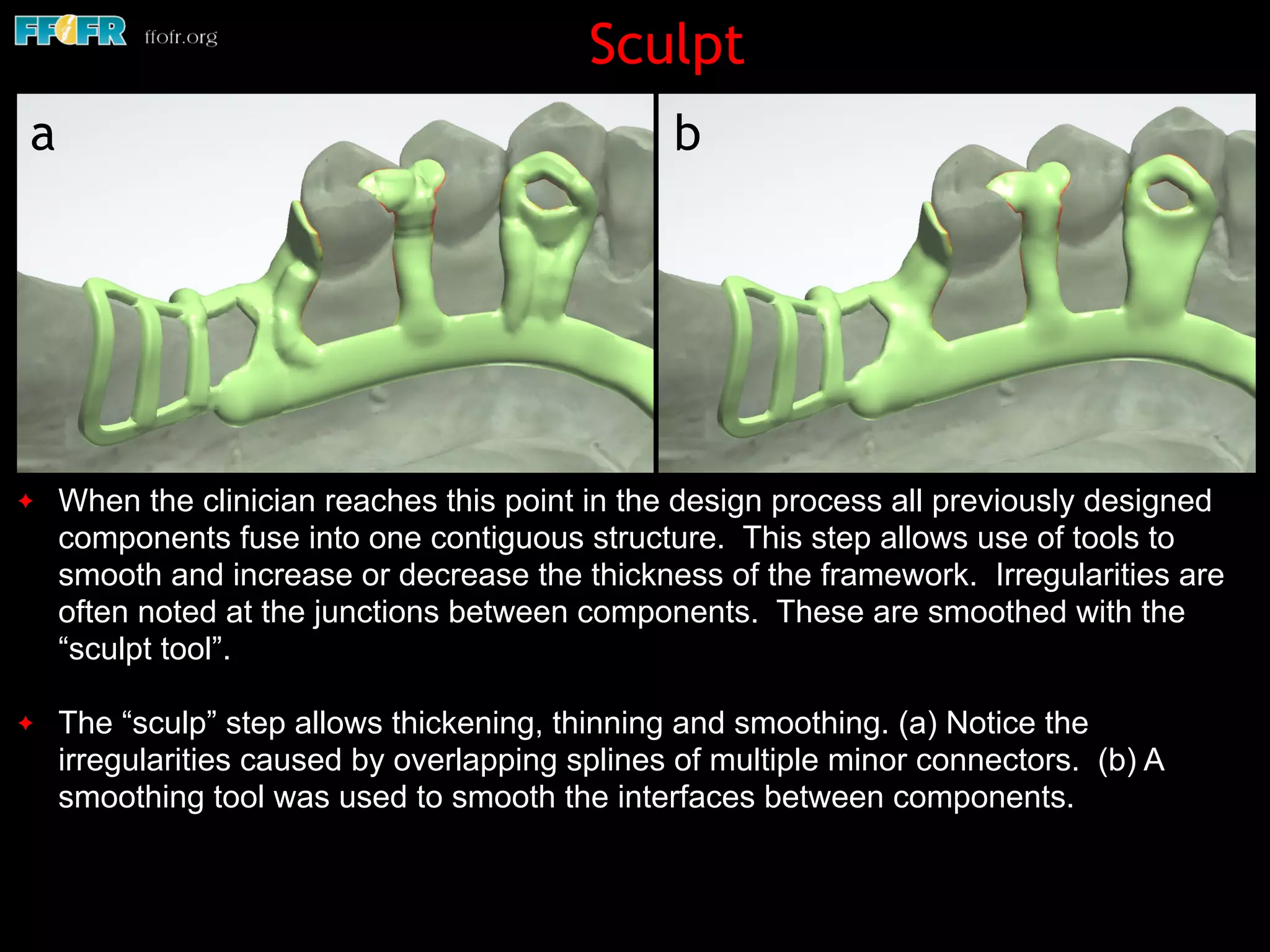 Sculpt
✦ When the clinician reaches this point in the design process all previously designed
components fuse into one contiguous structure. This step allows use of tools to
smooth and increase or decrease the thickness of the framework. Irregularities are
often noted at the junctions between components. These are smoothed with the
“sculpt tool”.
✦ The “sculp” step allows thickening, thinning and smoothing. (a) Notice the
irregularities caused by overlapping splines of multiple minor connectors. (b) A
smoothing tool was used to smooth the interfaces between components.
a b
 