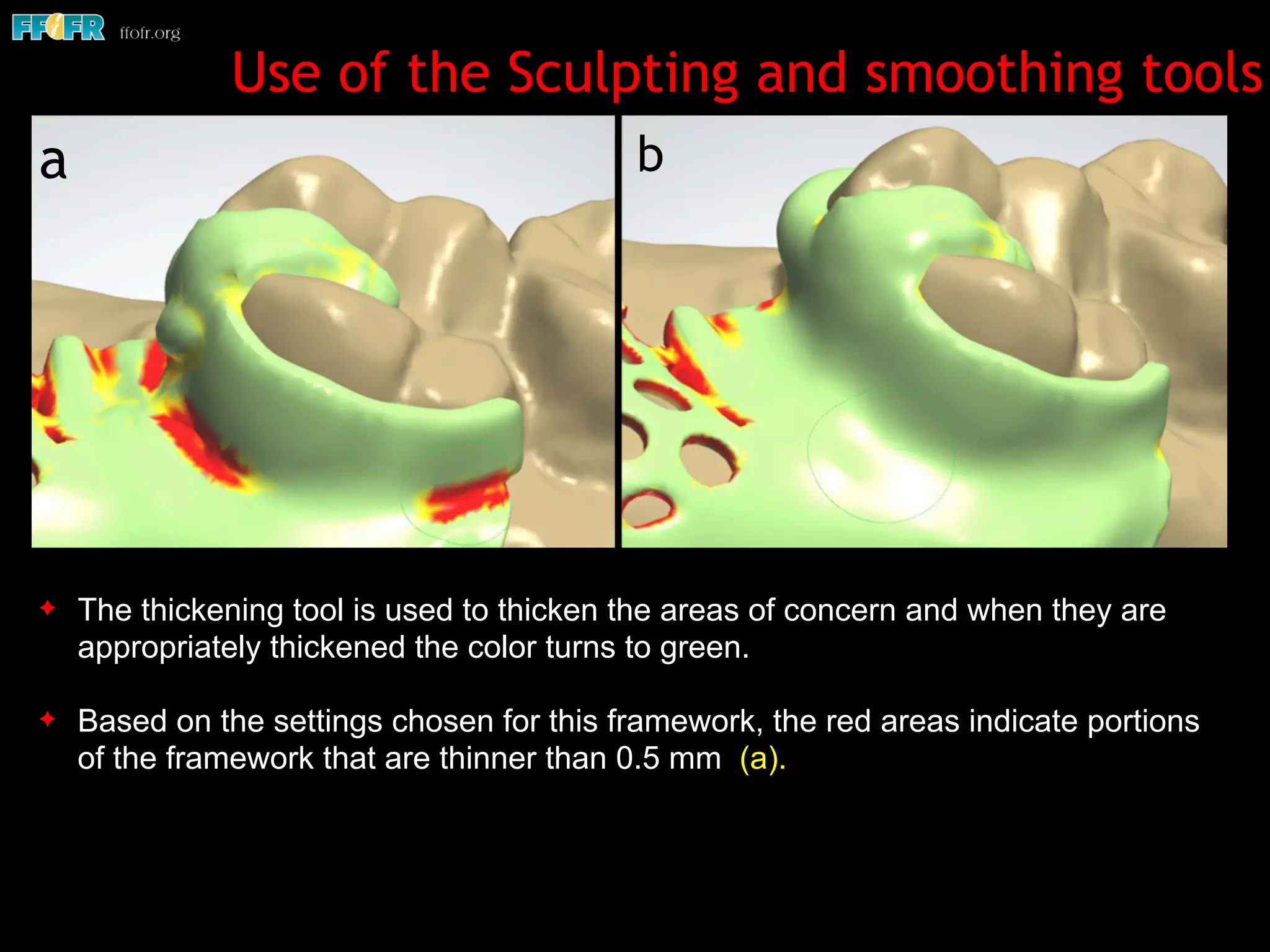 Use of the Sculpting and smoothing tools
✦ The thickening tool is used to thicken the areas of concern and when they are
appropriately thickened the color turns to green.
✦ Based on the settings chosen for this framework, the red areas indicate portions
of the framework that are thinner than 0.5 mm (a).
a b
 