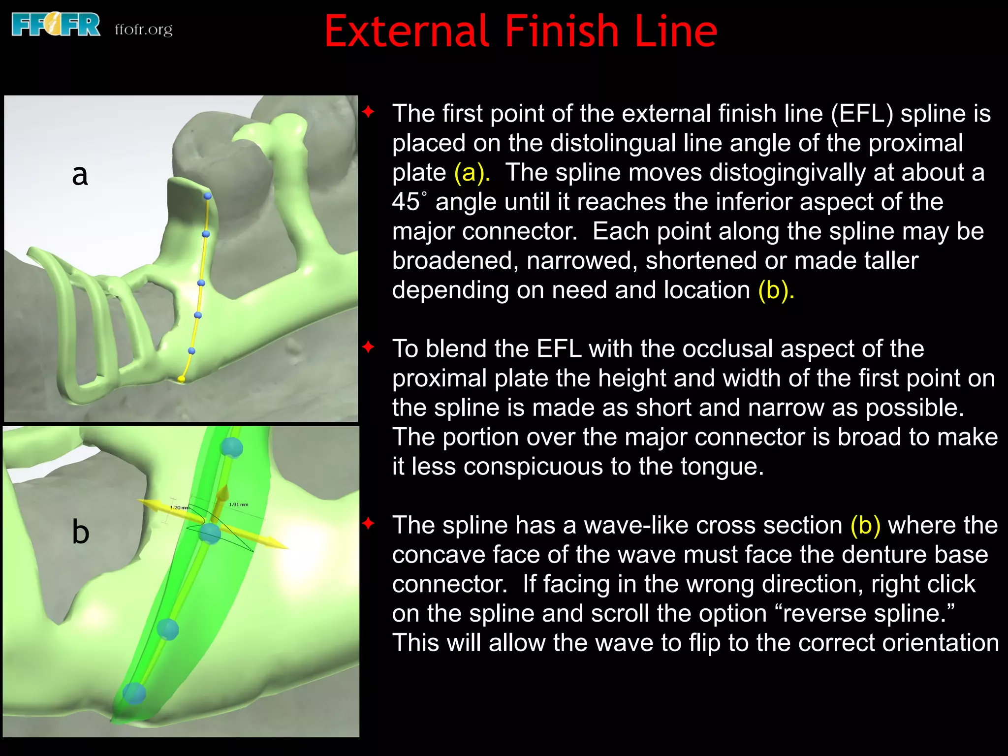 ✦ The first point of the external finish line (EFL) spline is
placed on the distolingual line angle of the proximal
plate (a). The spline moves distogingivally at about a
45˚ angle until it reaches the inferior aspect of the
major connector. Each point along the spline may be
broadened, narrowed, shortened or made taller
depending on need and location (b).
✦ To blend the EFL with the occlusal aspect of the
proximal plate the height and width of the first point on
the spline is made as short and narrow as possible.
The portion over the major connector is broad to make
it less conspicuous to the tongue.
✦ The spline has a wave-like cross section (b) where the
concave face of the wave must face the denture base
connector. If facing in the wrong direction, right click
on the spline and scroll the option “reverse spline.”
This will allow the wave to flip to the correct orientation
External Finish Line
a
b
 