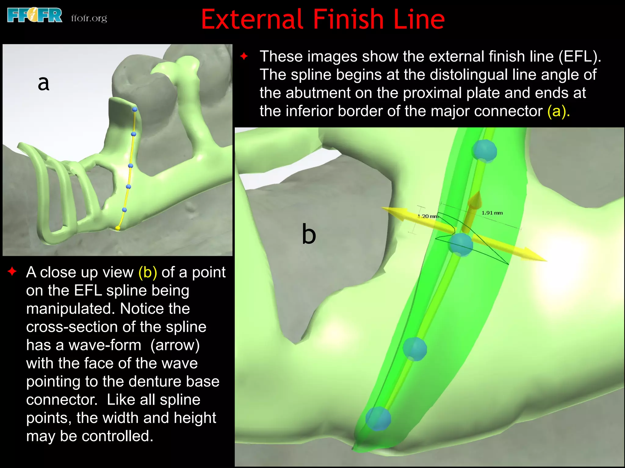 ✦ These images show the external finish line (EFL).
The spline begins at the distolingual line angle of
the abutment on the proximal plate and ends at
the inferior border of the major connector (a).
External Finish Line
✦ A close up view (b) of a point
on the EFL spline being
manipulated. Notice the
cross-section of the spline
has a wave-form (arrow)
with the face of the wave
pointing to the denture base
connector. Like all spline
points, the width and height
may be controlled.
a
b
 