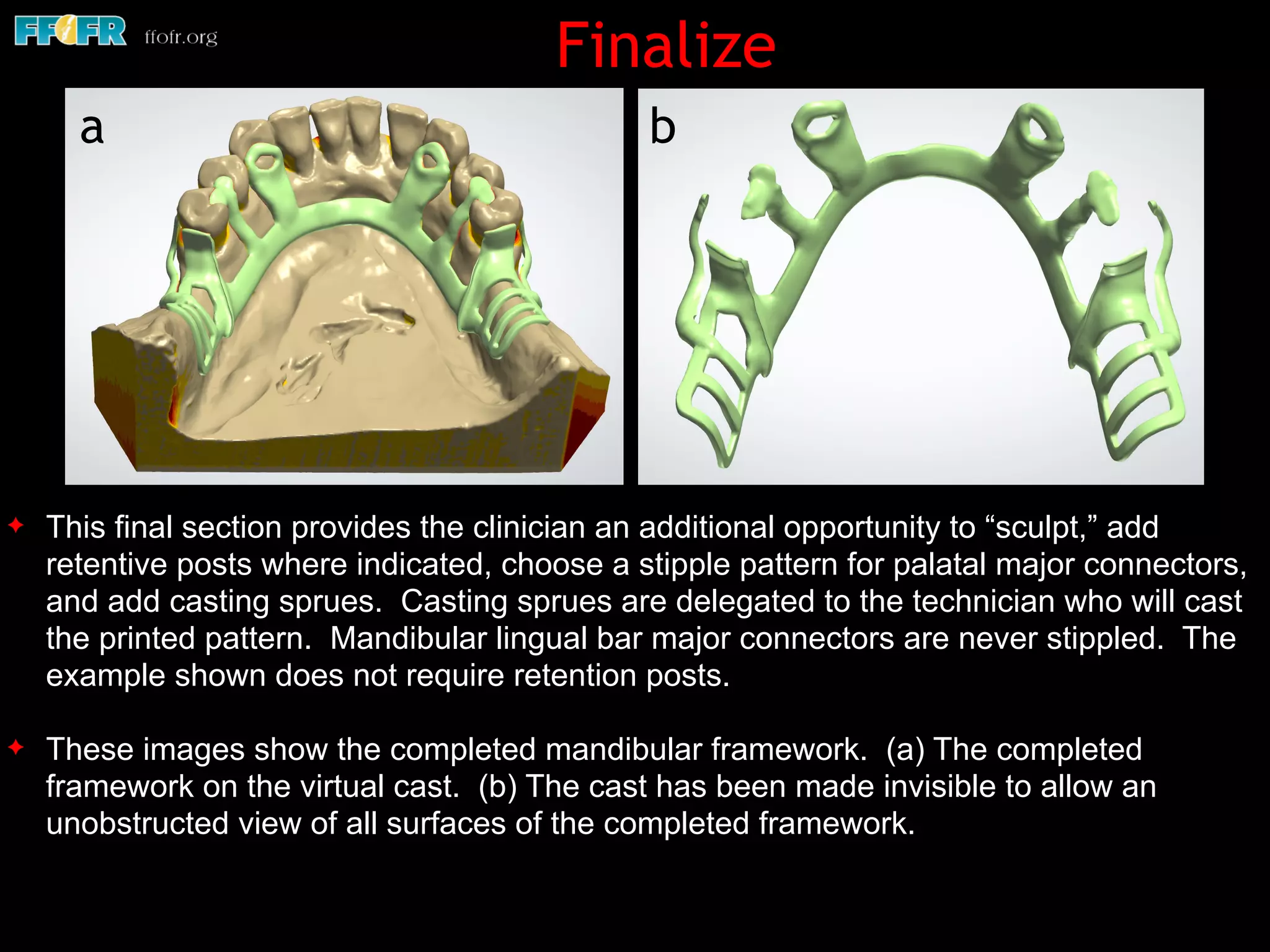✦ This final section provides the clinician an additional opportunity to “sculpt,” add
retentive posts where indicated, choose a stipple pattern for palatal major connectors,
and add casting sprues. Casting sprues are delegated to the technician who will cast
the printed pattern. Mandibular lingual bar major connectors are never stippled. The
example shown does not require retention posts.
✦ These images show the completed mandibular framework. (a) The completed
framework on the virtual cast. (b) The cast has been made invisible to allow an
unobstructed view of all surfaces of the completed framework.
Finalize
a b
 