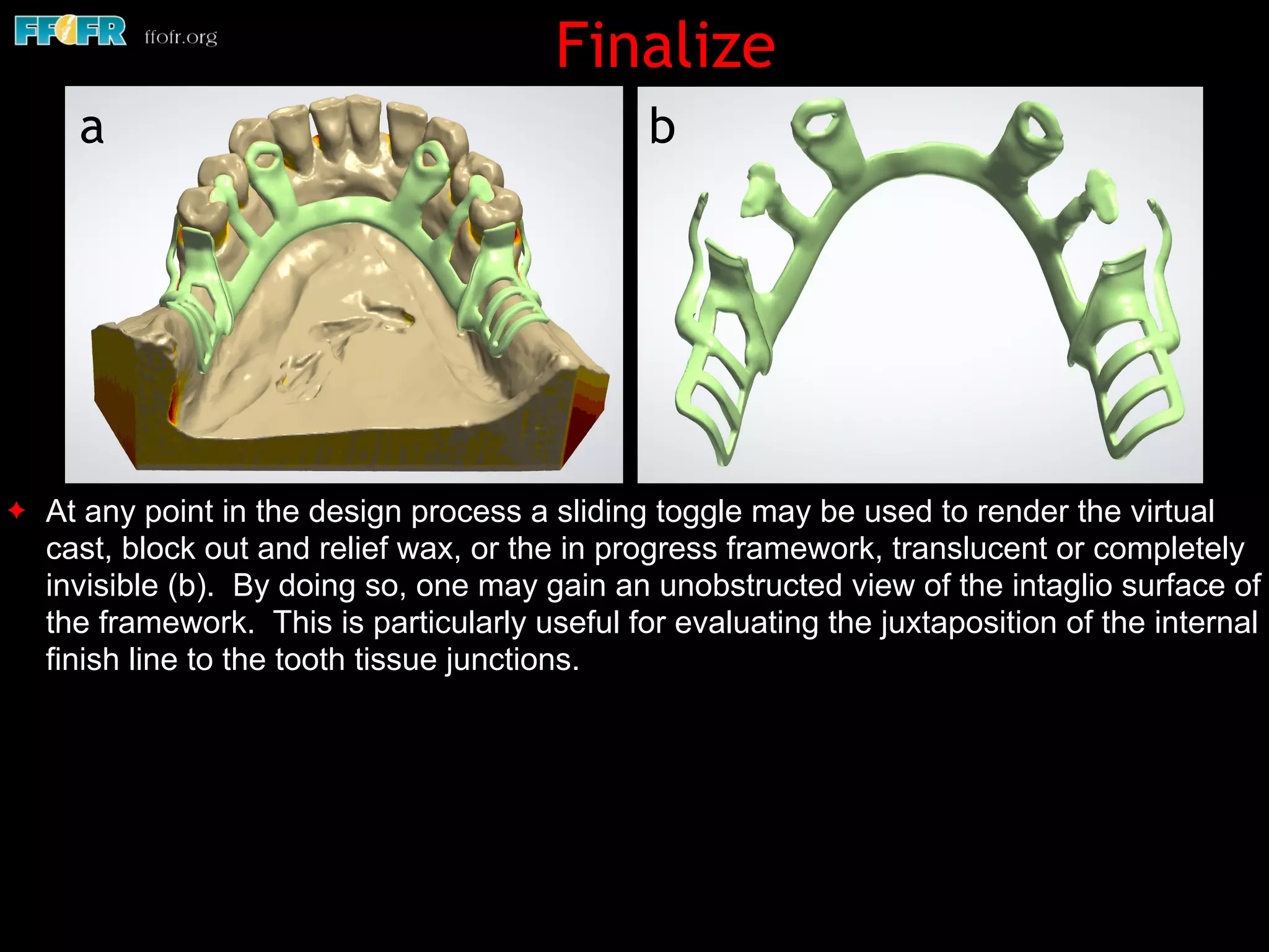 ✦ At any point in the design process a sliding toggle may be used to render the virtual
cast, block out and relief wax, or the in progress framework, translucent or completely
invisible (b). By doing so, one may gain an unobstructed view of the intaglio surface of
the framework. This is particularly useful for evaluating the juxtaposition of the internal
finish line to the tooth tissue junctions.
Finalize
ba
 