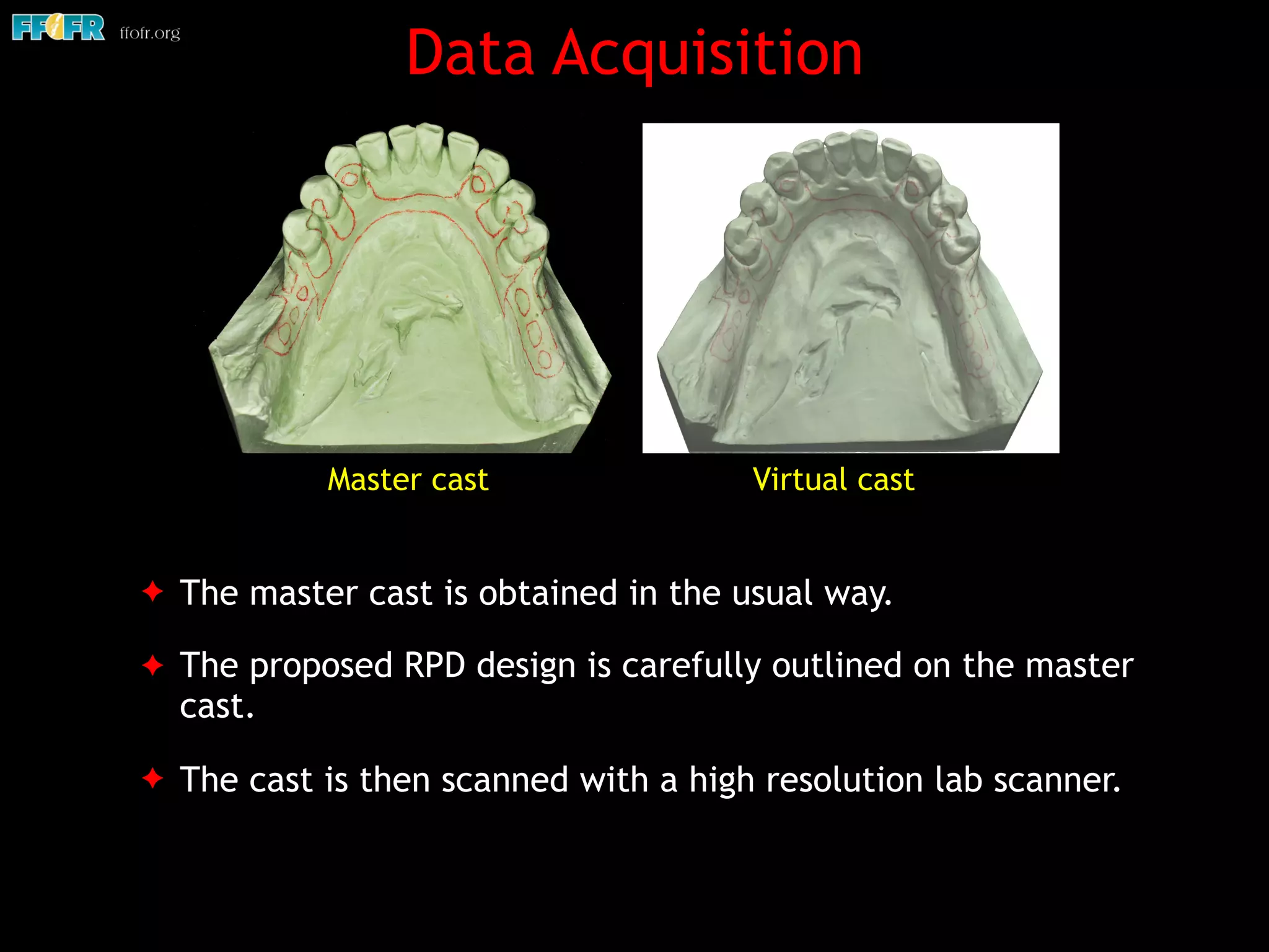 Data Acquisition
✦ The master cast is obtained in the usual way.
✦ The proposed RPD design is carefully outlined on the master
cast.
✦ The cast is then scanned with a high resolution lab scanner.
Virtual castMaster cast
 