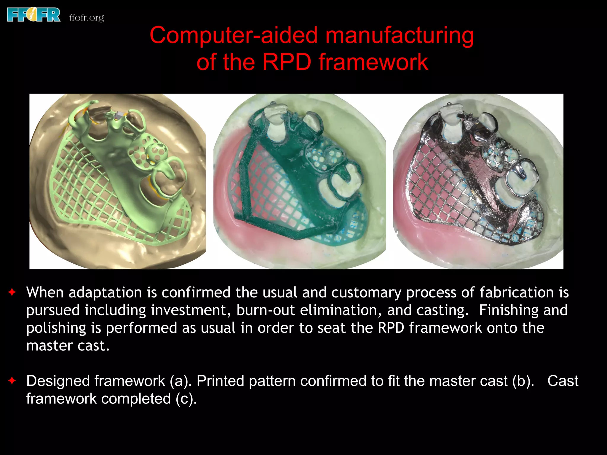 ✦ When adaptation is confirmed the usual and customary process of fabrication is
pursued including investment, burn-out elimination, and casting. Finishing and
polishing is performed as usual in order to seat the RPD framework onto the
master cast.
✦ Designed framework (a). Printed pattern confirmed to fit the master cast (b). Cast
framework completed (c).
Computer-aided manufacturing
of the RPD framework
 