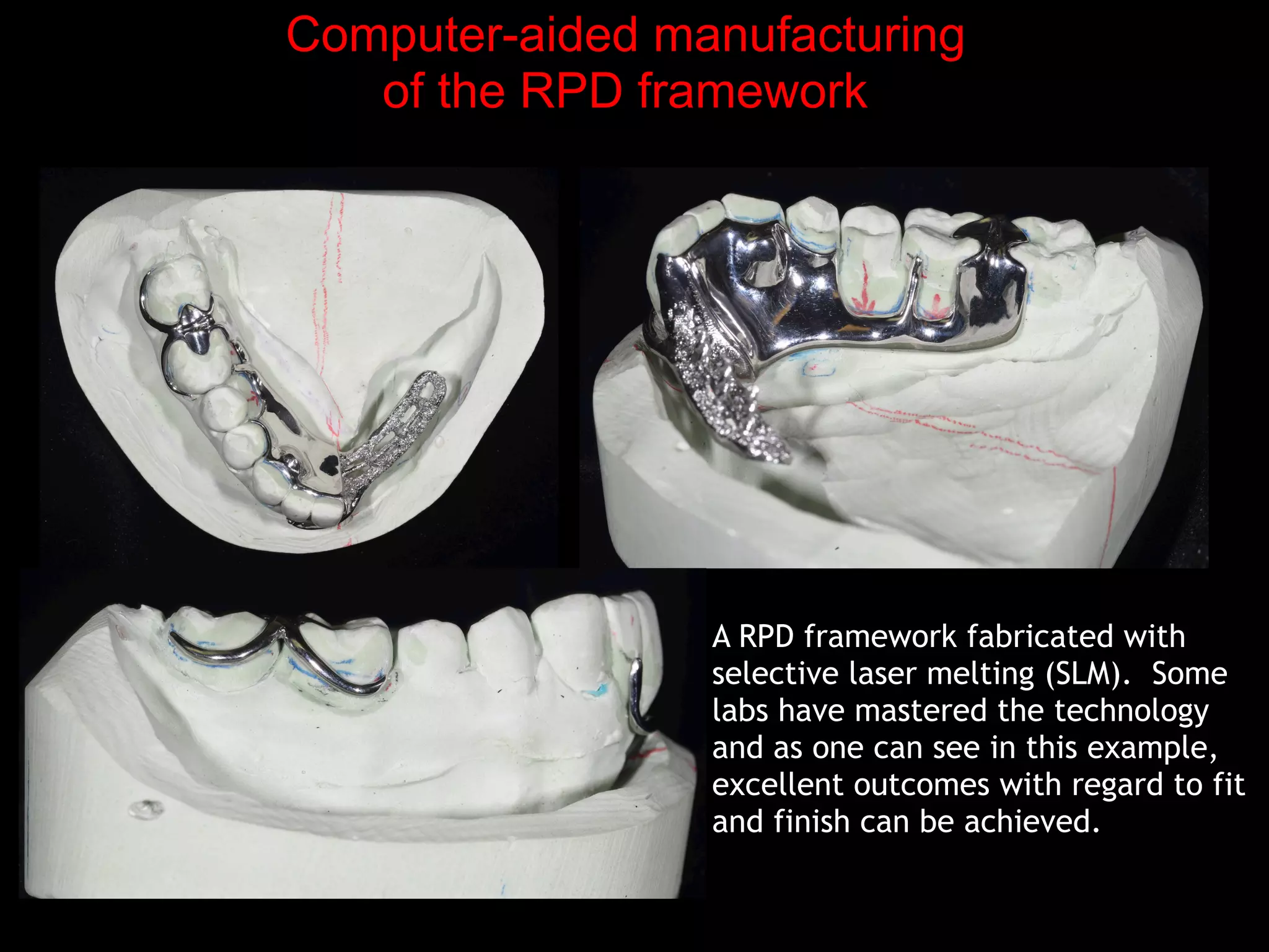 Computer-aided manufacturing
of the RPD framework
A RPD framework fabricated with
selective laser melting (SLM). Some
labs have mastered the technology
and as one can see in this example,
excellent outcomes with regard to fit
and finish can be achieved.
 