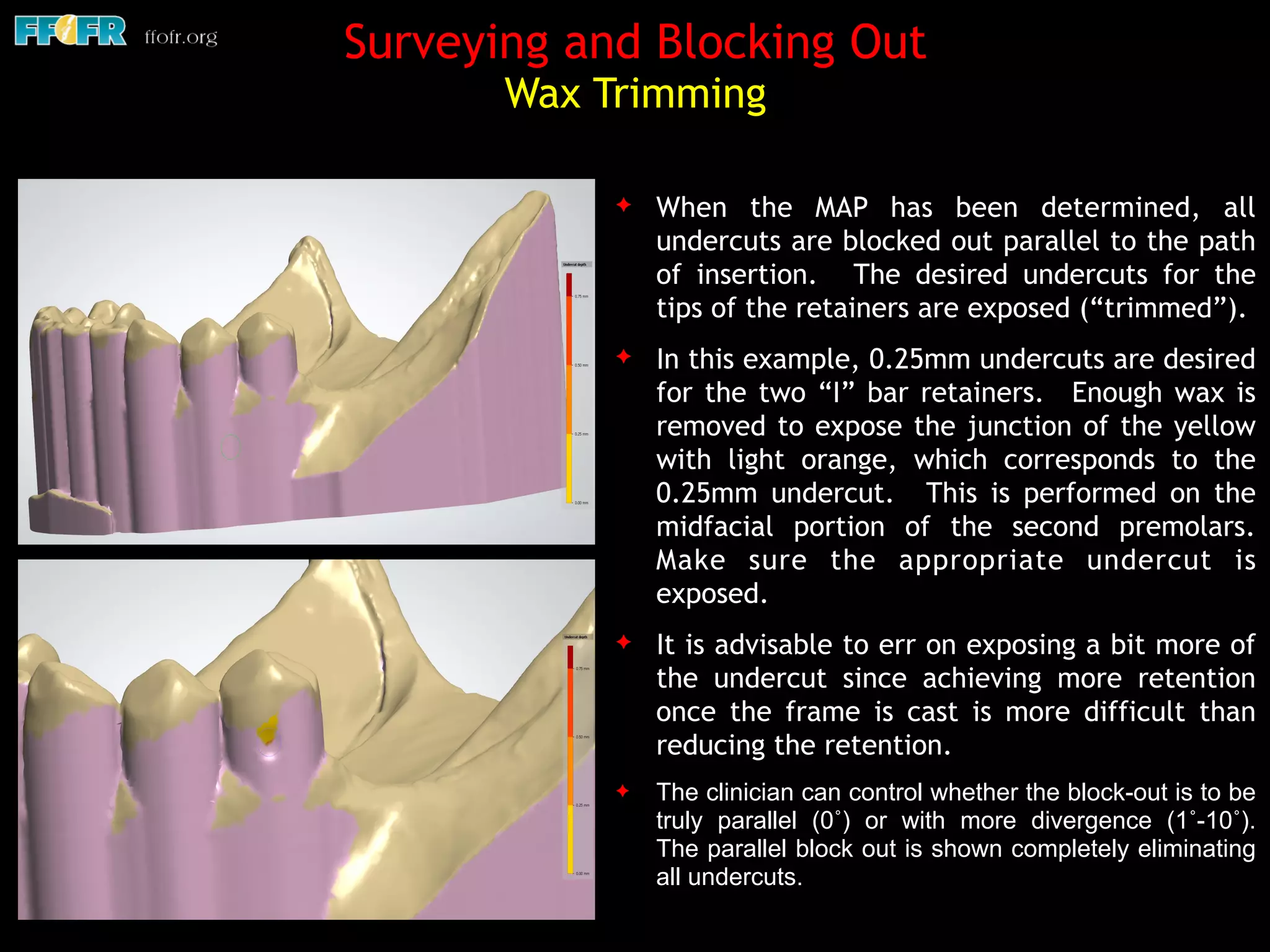 Surveying and Blocking Out  
Wax Trimming
✦ When the MAP has been determined, all
undercuts are blocked out parallel to the path
of insertion. The desired undercuts for the
tips of the retainers are exposed (“trimmed”).
✦ In this example, 0.25mm undercuts are desired
for the two “I” bar retainers. Enough wax is
removed to expose the junction of the yellow
with light orange, which corresponds to the
0.25mm undercut. This is performed on the
midfacial portion of the second premolars.
Make sure the appropriate undercut is
exposed.
✦ It is advisable to err on exposing a bit more of
the undercut since achieving more retention
once the frame is cast is more difficult than
reducing the retention.
✦ The clinician can control whether the block-out is to be
truly parallel (0˚) or with more divergence (1˚-10˚).
The parallel block out is shown completely eliminating
all undercuts.
 