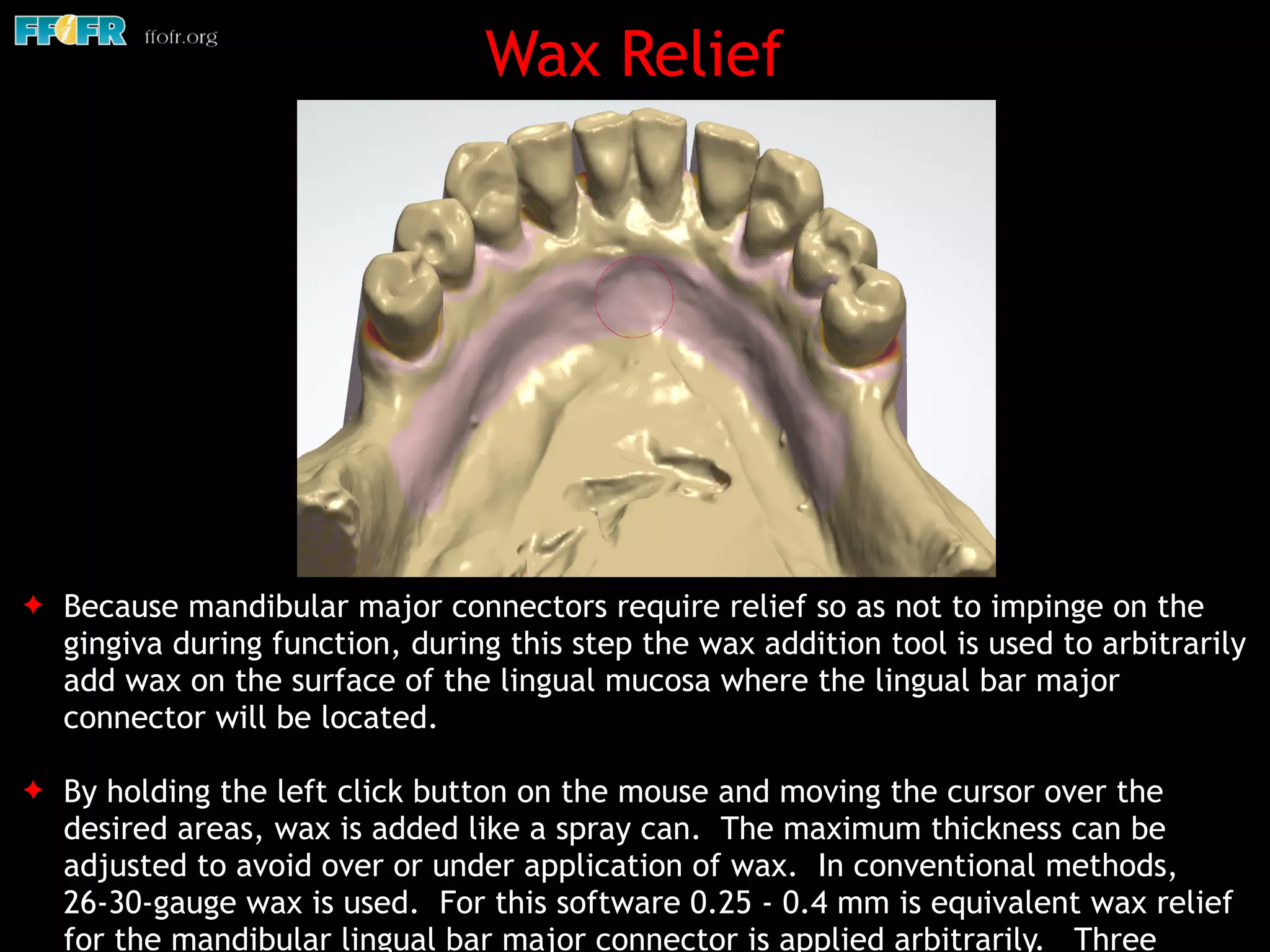 Wax Relief
✦ Because mandibular major connectors require relief so as not to impinge on the
gingiva during function, during this step the wax addition tool is used to arbitrarily
add wax on the surface of the lingual mucosa where the lingual bar major
connector will be located.
✦ By holding the left click button on the mouse and moving the cursor over the
desired areas, wax is added like a spray can. The maximum thickness can be
adjusted to avoid over or under application of wax. In conventional methods,
26-30-gauge wax is used. For this software 0.25 - 0.4 mm is equivalent wax relief
for the mandibular lingual bar major connector is applied arbitrarily. Three
 