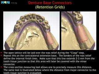 Denture Base Connectors
(Retention Grids)
✦ The open lattice will be laid over the wax relief during the “Clasp” step.
✦ Repeat this on the contralateral extension base. The borders of the wax relief
define the internal finish lines. Make sure that this line extends 2-3 mm from the
tooth tissue junction so that this area will later be covered with the minor
connector.
✦ The cross-section measuring tool allows one to precisely measure this distance.
The same tool is illustrated below where the distance from major connector to the
tooth tissue junction is evaluated.
 