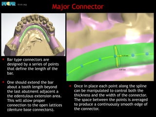Major Connector
✦ Bar type connectors are
designed by a series of points
that define the length of the
bar.
✦ One should extend the bar
about a tooth length beyond
the last abutment adjacent a
the edentulous extension area.
This will allow proper
connection to the open lattices
(denture base connectors).
✦ Once in place each point along the spline
can be manipulated to control both the
thickness and the width of the connector.
The space between the points is averaged
to produce a continuously smooth edge of
the connector.
 