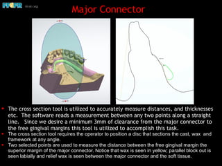 ✦ The cross section tool is utilized to accurately measure distances, and thicknesses
etc. The software reads a measurement between any two points along a straight
line. Since we desire a minimum 3mm of clearance from the major connector to
the free gingival margins this tool is utilized to accomplish this task.
✦ The cross section tool requires the operator to position a disc that sections the cast, wax and
framework at any angle.
✦ Two selected points are used to measure the distance between the free gingival margin the
superior margin of the major connector. Notice that wax is seen in yellow; parallel block out is
seen labially and relief wax is seen between the major connector and the soft tissue.
Major Connector
 