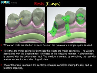 ✦ When two rests are abutted as seen here on the premolars, a single spline is used.
✦ Note that the minor connector connects the rest to the major connector. The window
associated with the cingulum rest is created in the following manner. A cingulum rest
is created with the occlusal rest tool. The window is created by combining the rest with
a minor connector as a short lingual plate.
✦ The anterior rest is open in the center to visualize complete seating the rest and to
facilitate cleaning.
Rests (Clasps)
 