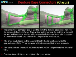 ✦ The same minor connector tool is used to form the denture base connector over
the previously laid relief wax. Begin with a spline forming the outline of the grid
pattern making sure to overlap with the proximal plate and the major connector.
In the example shown two cross struts complete the open lattice.
✦ The cross strut closest to the abutment tooth should be aligned with the
approach arm of the “I” bar retainer which is designed in the next segment.
✦ The denture base connector outline is formed within the perimeter of the relief
wax.
✦ Cross-struts are designed to complete the open lattice.
Denture Base Connectors (Clasps)
 