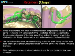✦ Select a retainer tool with a half-round cross section and place the first point of the
spline overlapping with a cross strut of the open lattice denture base connector.
Continue down the crest of the ridge about 3mm and swing mesially towards the
abutment tooth. Curve into the vertical arm and cross the tooth-gingival junction.
✦ The vertical arm should be parallel to the long axis of the tooth. Modify the half round
base and height to properly taper the vertical arm from 2mm at the bend to 1mm at its
terminus.
✦ Note that the retainer arm is aligned with the strut of the open lattice denture base
connector.
Retainers (Clasps)
 