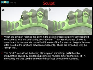 Sculpt
✦ When the clinician reaches this point in the design process all previously designed
components fuse into one contiguous structure. This step allows use of tools to
smooth and increase or decrease the thickness of the framework. Irregularities are
often noted at the junctions between components. These are smoothed with the
“sculpt tool”.
✦ The “sculp” step allows thickening, thinning and smoothing. (a) Notice the
irregularities caused by overlapping splines of multiple minor connectors. (b) A
smoothing tool was used to smooth the interfaces between components.
a b
 