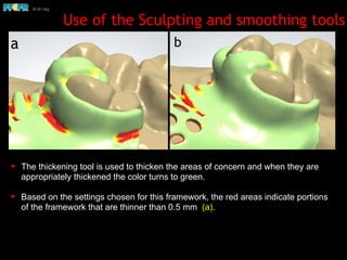 Use of the Sculpting and smoothing tools
✦ The thickening tool is used to thicken the areas of concern and when they are
appropriately thickened the color turns to green.
✦ Based on the settings chosen for this framework, the red areas indicate portions
of the framework that are thinner than 0.5 mm (a).
a b
 