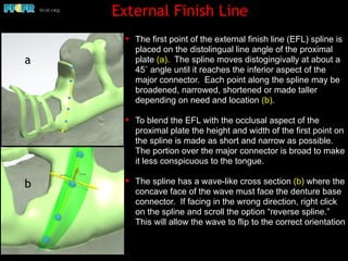 ✦ The first point of the external finish line (EFL) spline is
placed on the distolingual line angle of the proximal
plate (a). The spline moves distogingivally at about a
45˚ angle until it reaches the inferior aspect of the
major connector. Each point along the spline may be
broadened, narrowed, shortened or made taller
depending on need and location (b).
✦ To blend the EFL with the occlusal aspect of the
proximal plate the height and width of the first point on
the spline is made as short and narrow as possible.
The portion over the major connector is broad to make
it less conspicuous to the tongue.
✦ The spline has a wave-like cross section (b) where the
concave face of the wave must face the denture base
connector. If facing in the wrong direction, right click
on the spline and scroll the option “reverse spline.”
This will allow the wave to flip to the correct orientation
External Finish Line
a
b
 