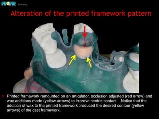 ✦ Printed framework remounted on an articulator, occlusion adjusted (red arrow) and
wax additions made (yellow arrows) to improve centric contact. Notice that the
addition of wax to the printed framework produced the desired contour (yellow
arrows) of the cast framework.
Alteration of the printed framework pattern
 