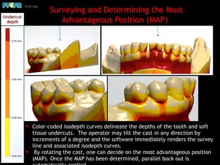 Surveying and Determining the Most
Advantageous Position (MAP)
✦ Color-coded isodepth curves delineate the depths of the tooth and soft
tissue undercuts. The operator may tilt the cast in any direction by
increments of a degree and the software immediately renders the survey
line and associated isodepth curves.
✦ By rotating the cast, one can decide on the most advantageous position
(MAP). Once the MAP has been determined, parallel bock out is
Undercut
depth
 