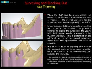 Surveying and Blocking Out  
Wax Trimming
✦ When the MAP has been determined, all
undercuts are blocked out parallel to the path
of insertion. The desired undercuts for the
tips of the retainers are exposed (“trimmed”).
✦ In this example, 0.25mm undercuts are desired
for the two “I” bar retainers. Enough wax is
removed to expose the junction of the yellow
with light orange, which corresponds to the
0.25mm undercut. This is performed on the
midfacial portion of the second premolars.
Make sure the appropriate undercut is
exposed.
✦ It is advisable to err on exposing a bit more of
the undercut since achieving more retention
once the frame is cast is more difficult than
reducing the retention.
✦ The clinician can control whether the block-out is to be
truly parallel (0˚) or with more divergence (1˚-10˚).
The parallel block out is shown completely eliminating
all undercuts.
 