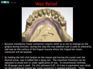 Wax Relief
✦ Because mandibular major connectors require relief so as not to impinge on the
gingiva during function, during this step the wax addition tool is used to arbitrarily
add wax on the surface of the lingual mucosa where the lingual bar major
connector will be located.
✦ By holding the left click button on the mouse and moving the cursor over the
desired areas, wax is added like a spray can. The maximum thickness can be
adjusted to avoid over or under application of wax. In conventional methods,
26-30-gauge wax is used. For this software 0.25 - 0.4 mm is equivalent wax relief
for the mandibular lingual bar major connector is applied arbitrarily. Three
 
