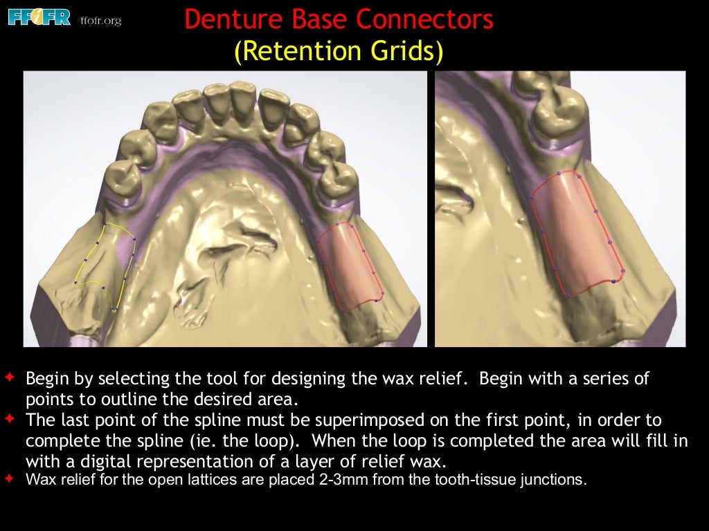 Digital Design of Mandibular Removable Partial Dentures