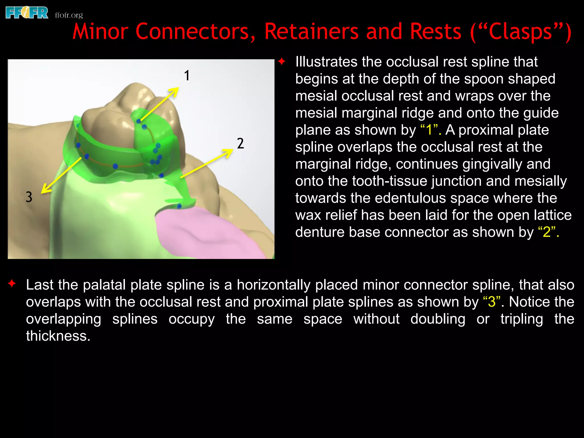Digital design of maxillary of rpd's | PDF