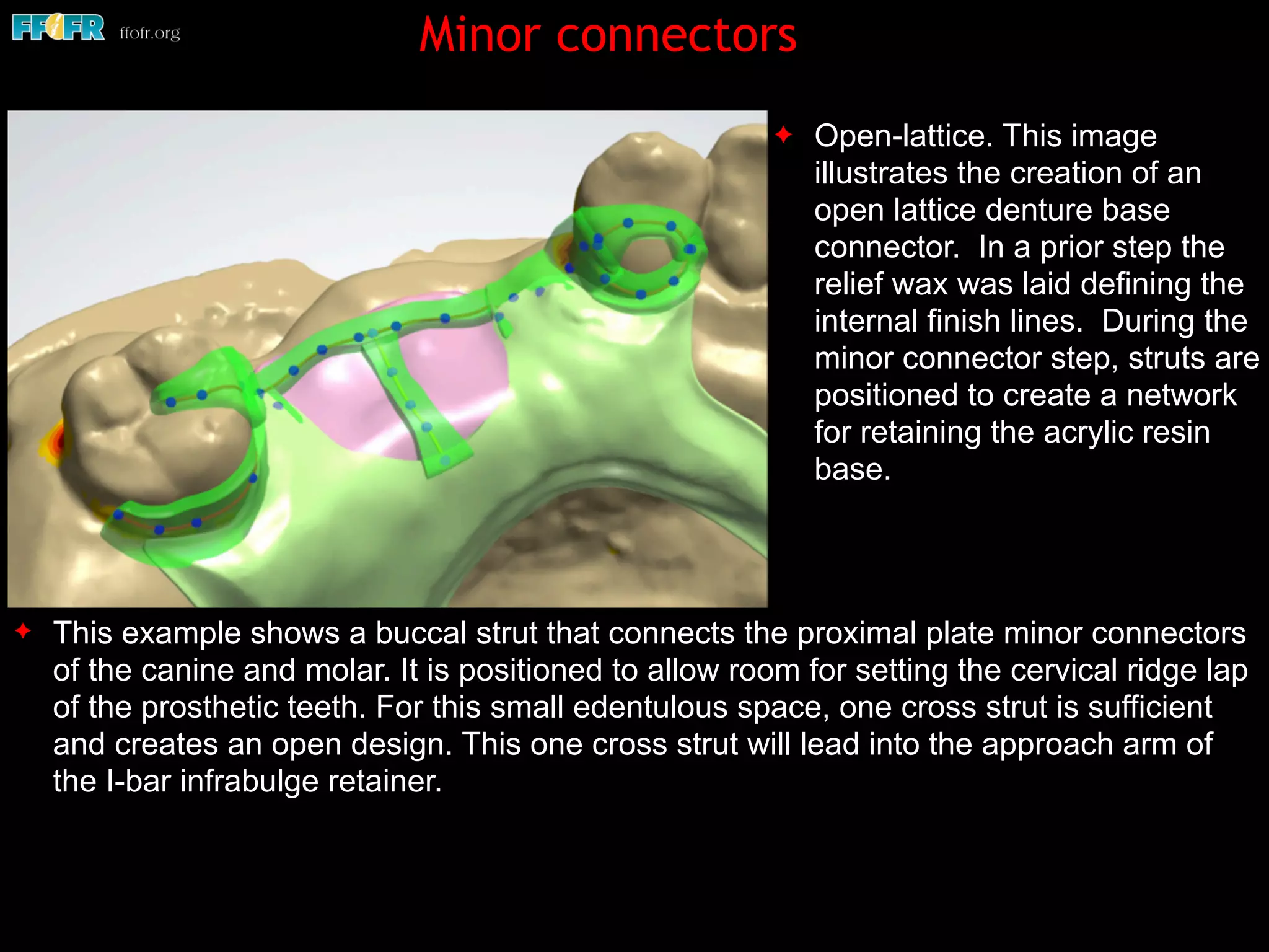 Digital design of maxillary of rpd's | PDF