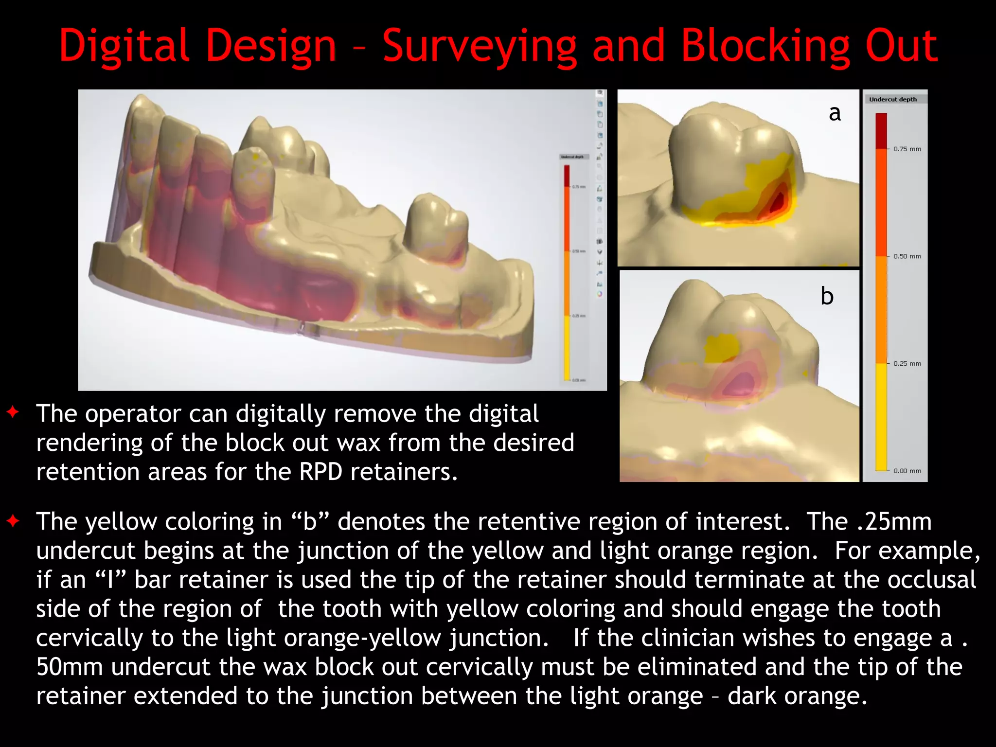 Digital design of maxillary of rpd's | PDF