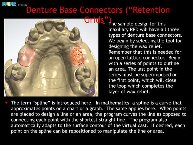K2 Rpd Maxilaly Digital design of maxillary of rpd's | PDF